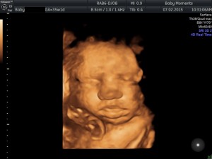 35 WKS 4d baby scan Reading  